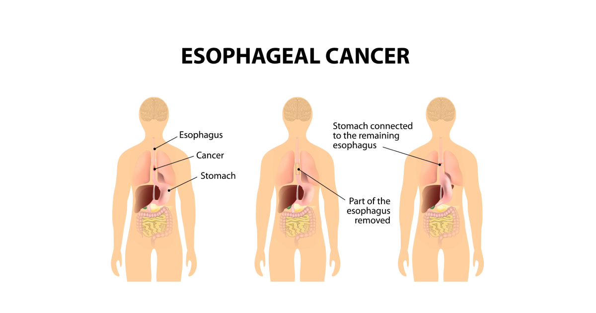 Pipac Cure for abdominal cancer and chest cavities_article