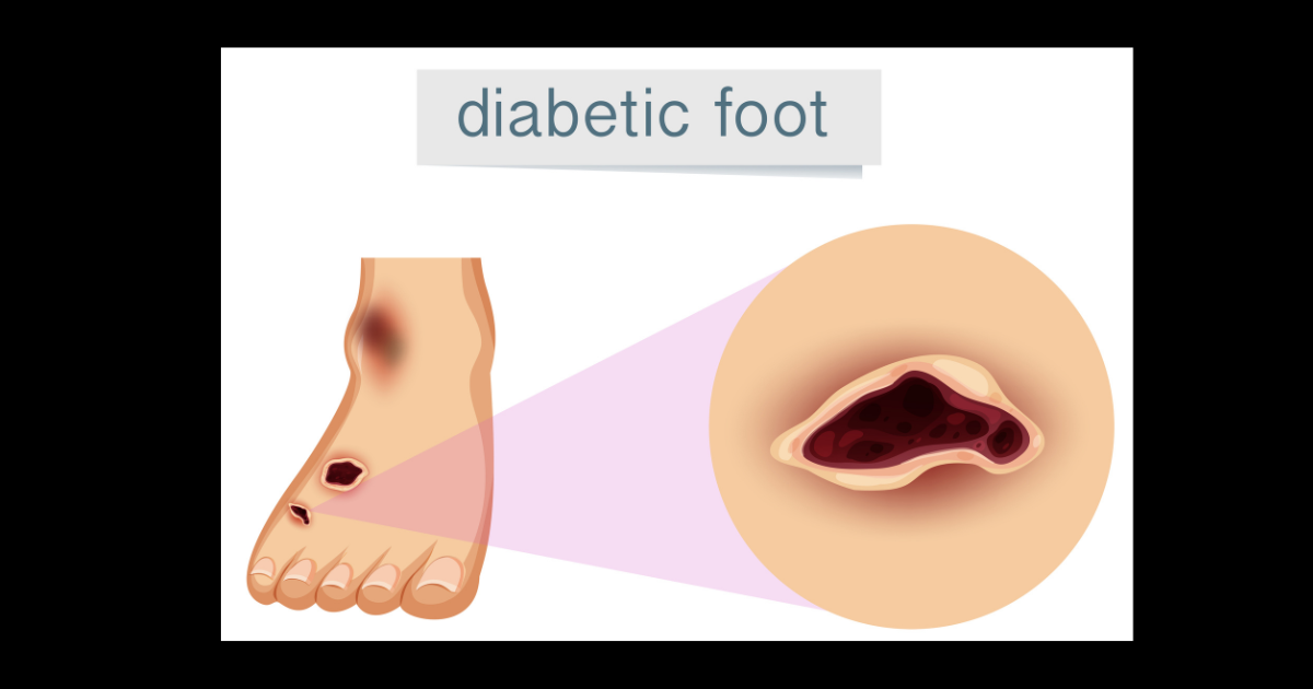 Alkem Laboratories Ltd. to launch State of the Art Technology for Diabetic Foot Ulcer Management for the first time in India