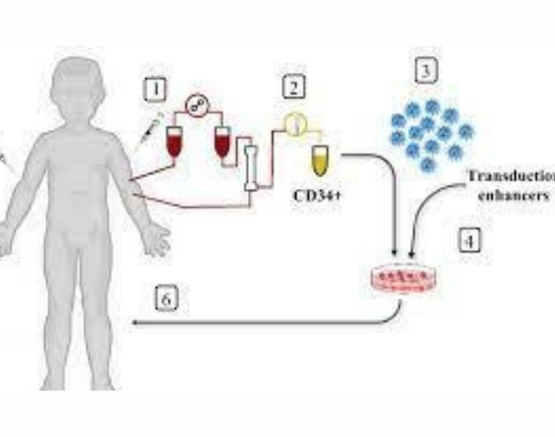 Gene therapy for hemoglobinopathies