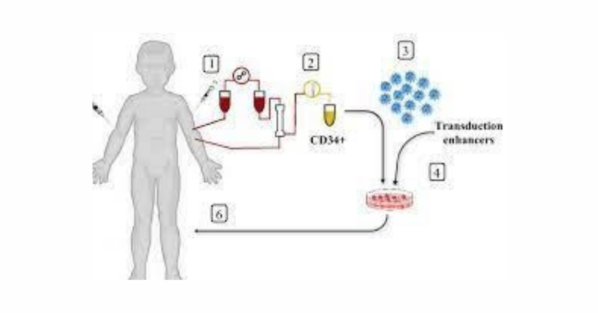 Gene therapy for hemoglobinopathies