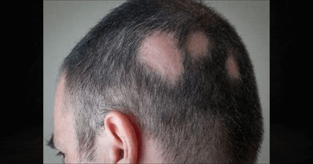 A Promising Oral Drug For Severe Alopecia