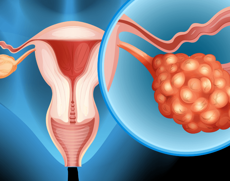 Adolescent Polycystic ovarian syndrome An entity well known but still unknown